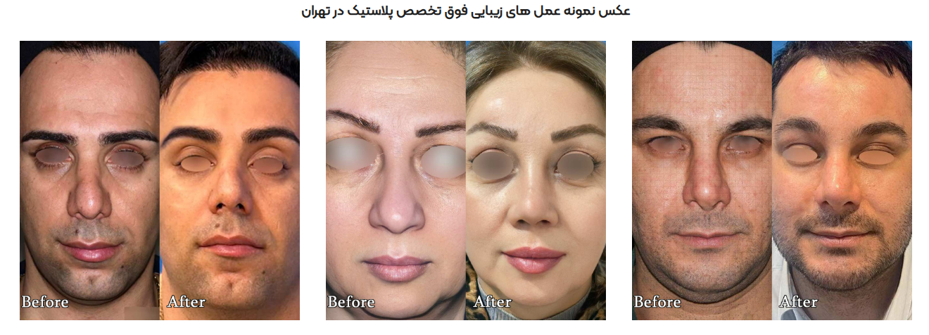 نحوه پانسمان بعد از لیفت صورت و پیشانی
