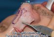 پیوند غضروف از گوش یا دنده؛ چه زمانی برای عمل بینی لازم می شود و چرا؟