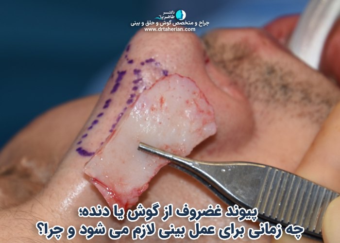 پیوند غضروف از گوش یا دنده؛ چه زمانی برای عمل بینی لازم می شود و چرا؟