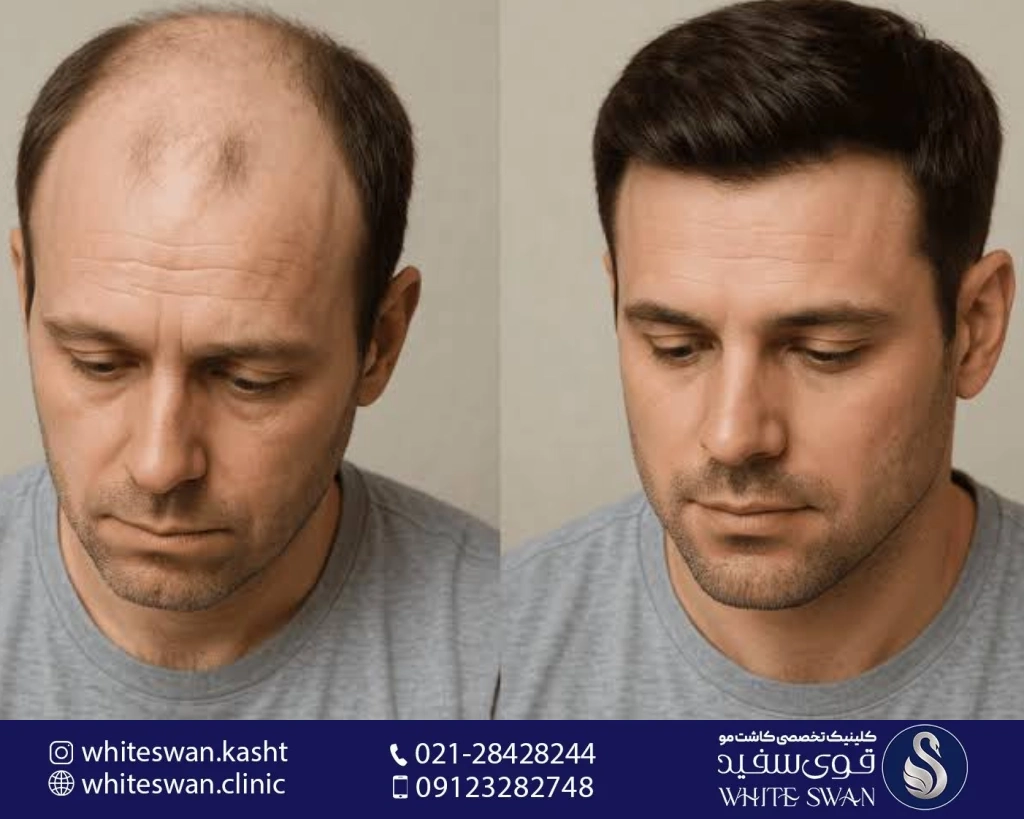 از درمان ریزش مو تا کاشت مو؛ چگونه بهترین مسیر را برای داشتن موهایی پرپشت انتخاب کنیم؟