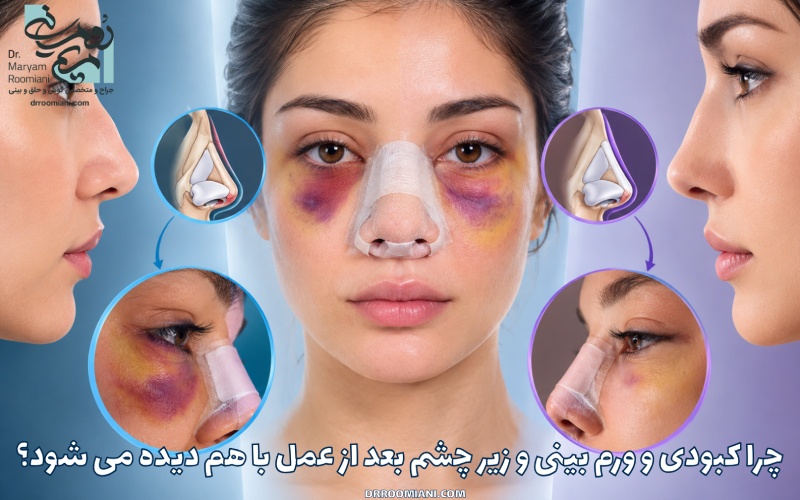 چرا کبودی و ورم بینی و زیر چشم بعد از عمل با هم دیده می شود؟